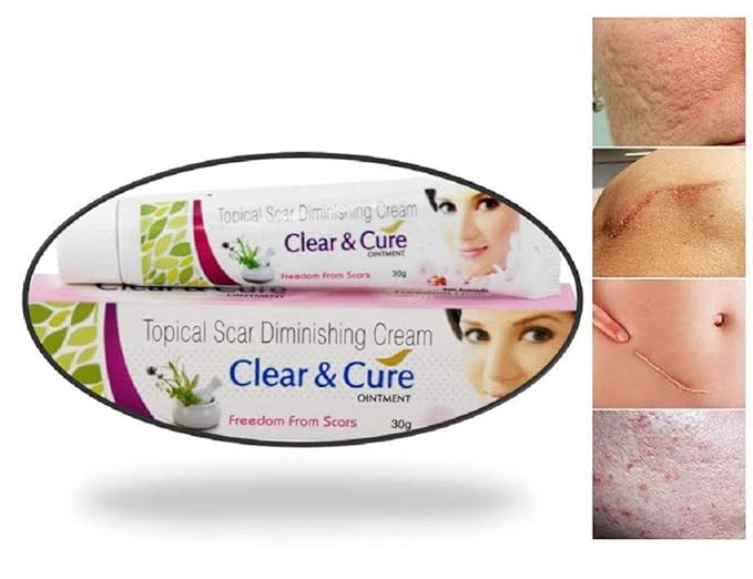 AZAZ Afflatus Ayurvedic Clear & Cure Anti Acne & Scar Removal Cream || Anti Pigmentation, Anti Blemish || Effective on Burn, Stretch & Post Pregnancy Marks- 30gm (Pack of 3)