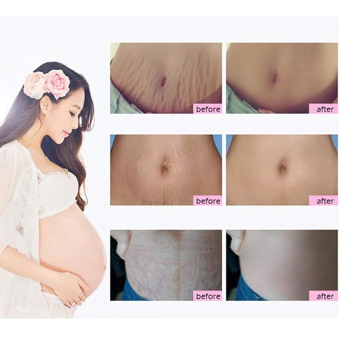 3pcs Scars Removal Cream, Mango Remove Pregnancy Scars Cream Stretches Marks Treatment Maternity Repair Firming Skin