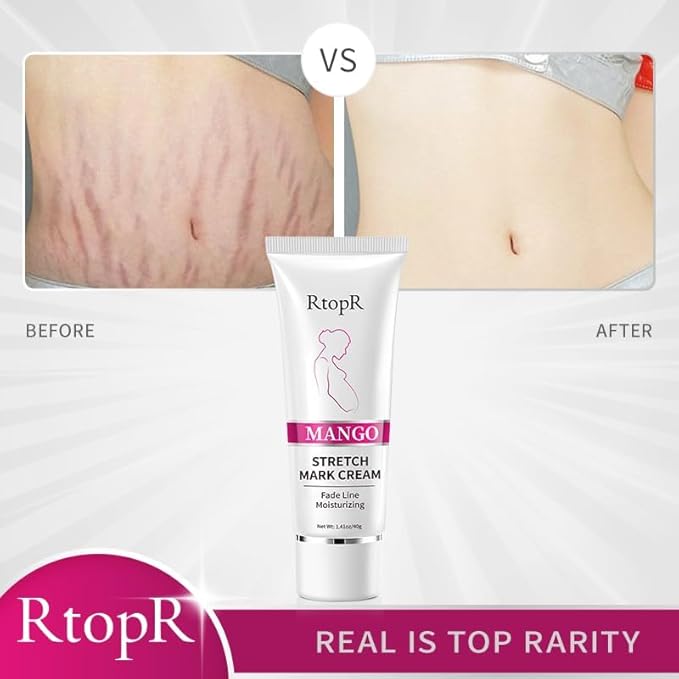1 PCS Stretch Marks and Scar Cream, Stretch Mark and Scar Removal Cream for Pregnancy, Belly Creams for Wrinkles, Obesity Fat Marks Scars Moisturizing, Remove Marks