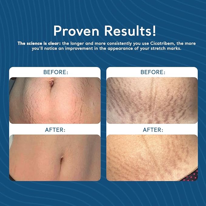Cicatribem Stretch Mark Cream 150g – Dermal Regenerator, Body Moisturizer, Suitable for All Skin Types, Safe for Pregnant Women