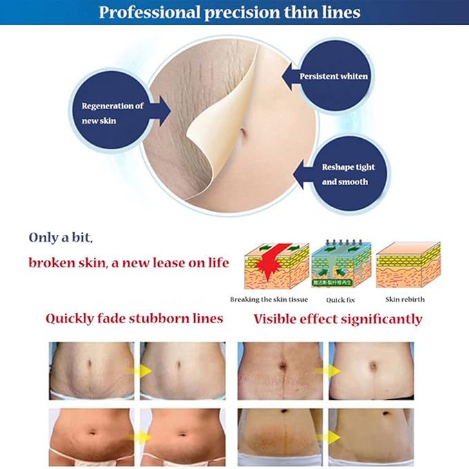 AICHUN BEAUTY Stretch Marks Cream Snail Extract Reduce Skin Scars Remove Damaged Skin Cells 120g/4.23oz