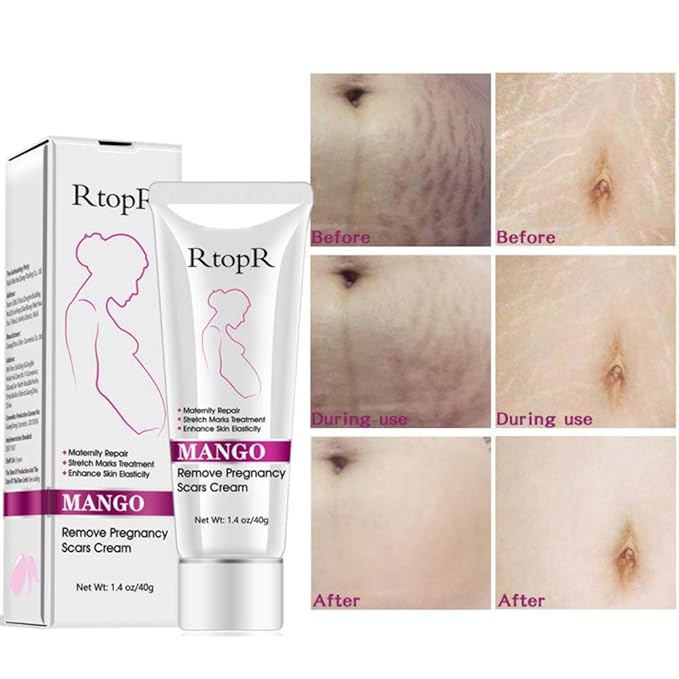 Ofanyia Stretch Mark Removal Cream Repair Scars Stretch Marks Remove Pregnancy Scar Cream