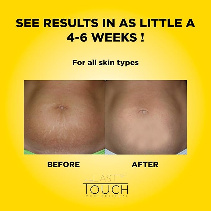 Pregnancy & Postpartum Skincare for Stretch Marks-Body Oil for Scars, Stretch Marks and Moisturizing-Safe for Pregnancy & Breastfeeding - Paraben-Free-8 Different Natural and Pure Oils-5.07 Fl Oz.