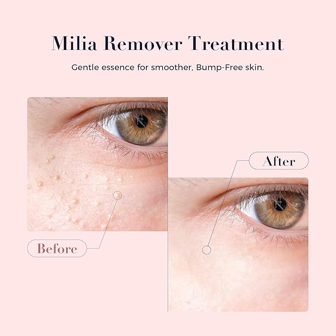 Milia Bump Remover for Eye & Face, Milia Spot Remover Treatment Serum with Salicylic Acid,Milia Acne Cream,Fat Granule Clearing Skin Essence
