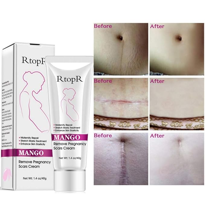Ofanyia Stretch Mark Removal Cream Repair Scars Stretch Marks Remove Pregnancy Scar Cream