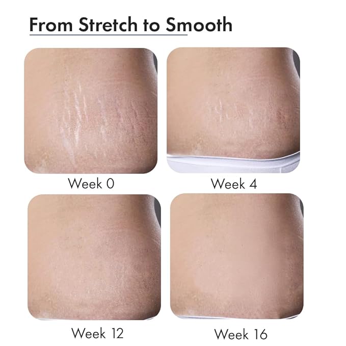 Anveya Stretch Marks Expert Serum Cream | Prevents & Reduces Appearance of New (Red) and Old (White) Stretchmarks | Powered by Striover™, Rosehip Oil & Squalane | Vegan and Cruelty-free | For Men