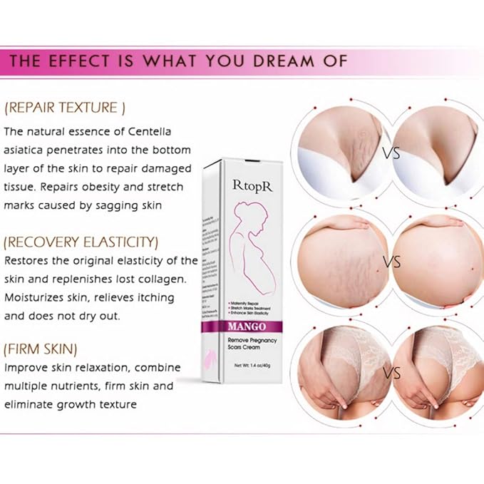 3pcs Scars Removal Cream, Mango Remove Pregnancy Scars Cream Stretches Marks Treatment Maternity Repair Firming Skin