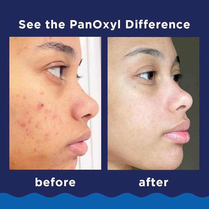 PanOxyl 10% Benzoyl Peroxide Acne Foaming Wash, Maximum Strength, Daily Acne-Fighting Face & Body Cleanser, Face Wash to Clear, Treat and Prevent Acne Pimples and Stubborn Breakouts, 5.5 Oz, Pack of 2