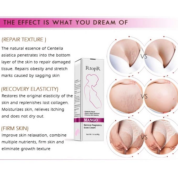 Mango Stretch Marks and Scar Cream, Stretch Mark and Scar Removal Cream for Pregnancy, Belly Creams for Wrinkles, Obesity Fat Marks Scars Moisturizing, Remove Marks (40g)