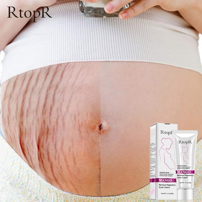 Ofanyia Stretch Mark Removal Cream Repair Scars Stretch Marks Remove Pregnancy Scar Cream