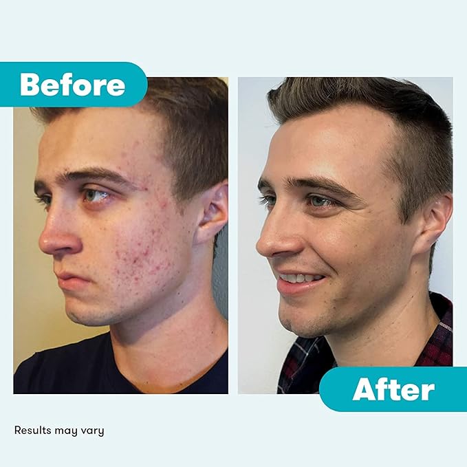 Proactiv Acne Cleanser - Benzoyl Peroxide Face Wash and Acne Treatment - Daily Facial Cleanser and Hyularonic Acid Moisturizer with Exfoliating Beads - 90 Day Supply, 6 Fl Oz