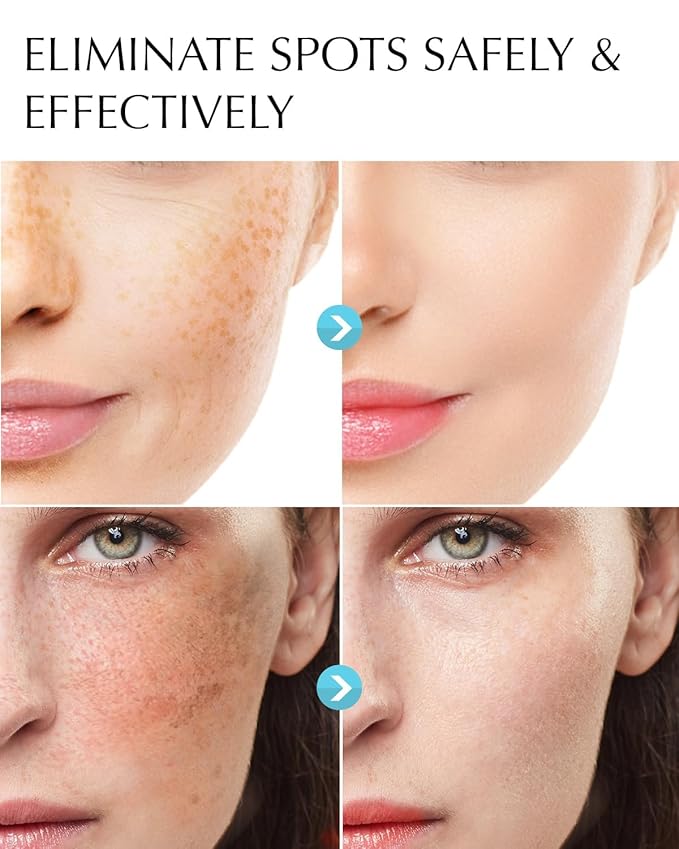 Enaskin Dark Spot Remover Cream: 2 Pack Value - Hyperpigmentation Corrector Targeting Dark Spots, Sun Spots, Freckles, Melasma & Age Spots - Dark Spot Corrector Serum for Women & Men