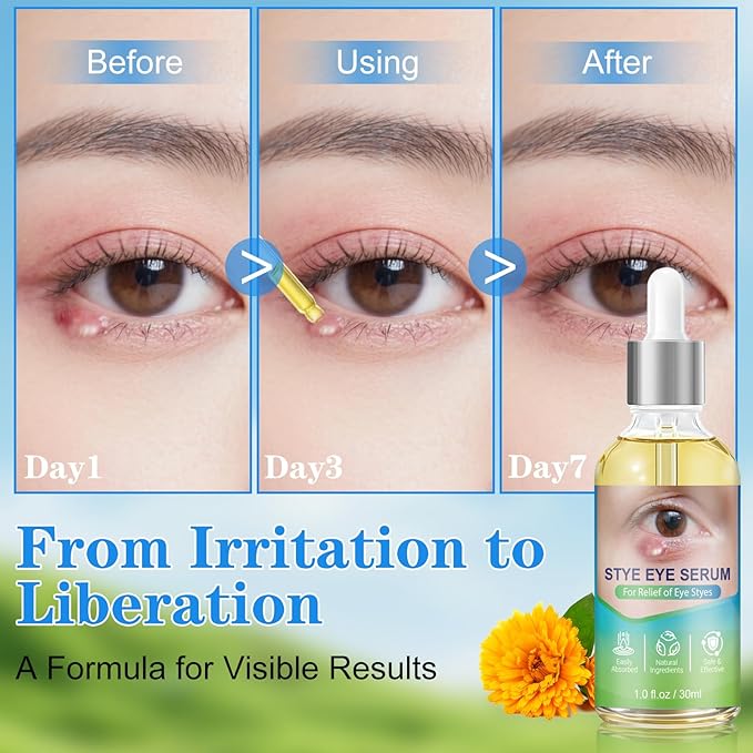Stye Eye Relief Serum Natural Eyelid Drops for Styes Blepharitis & Chalazion Fast-Acting Relieve Eye Irritation Redness & Swelling Gentle Formula 1.01 Fl oz/30 Ml
