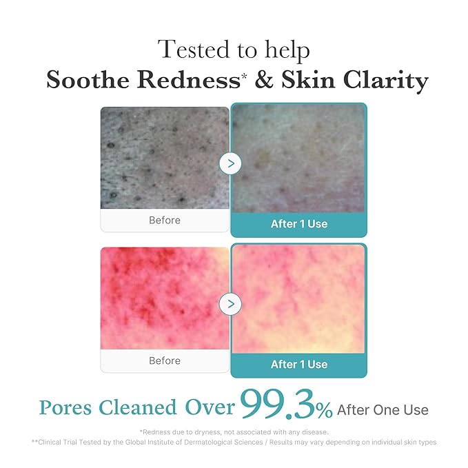 medicube Facial Cleanser Azelaic Acid Whip Cleanser | Soothing Cleansing Foam for Troubled Skin | Ideal for use after spot care, Excess Sebum Control | Niacinamide, Glycerin | Korean Skincare, 4.23 oz