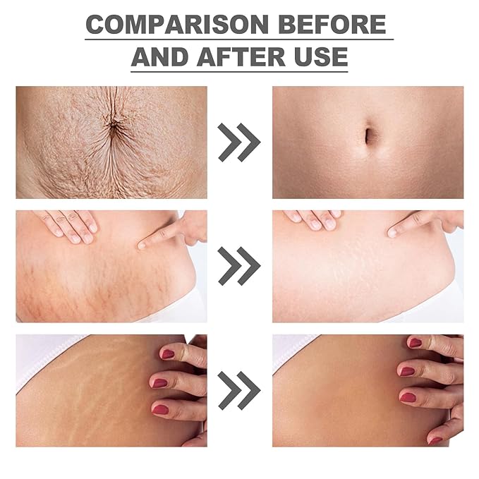 Silicone Patches for Stretch Marks, Anti Wrinkle Stretch Removal Sheet for Pregnant Women, Washable Reusable Skin Lifting & Tightening Silicone Tummy Sticker Belly Stickers Stretch Marks Pad (2pcs)