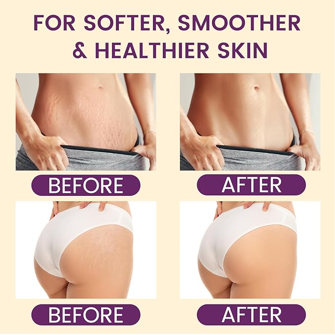 AOAO Shea Body Butter for Stretch Marks Pregnancy, Deeply Nourishing & Safe Moisturizer with Honey, Coconut & Vitamin-Rich Formula for Pregnant Women, Helps Soothe & Moisturize Stretch Marks, 7.05oz