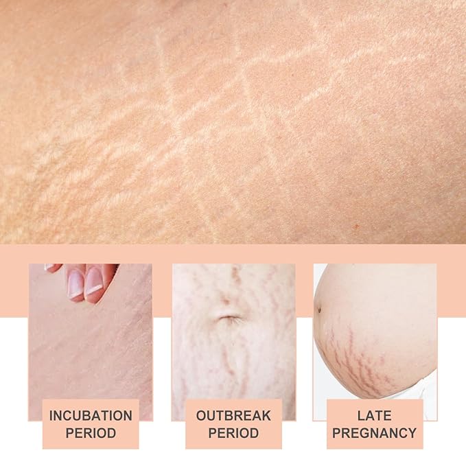 Silicone Patches for Stretch Marks, Anti Wrinkle Stretch Removal Sheet for Pregnant Women, Washable Reusable Skin Lifting & Tightening Silicone Tummy Sticker Belly Stickers Stretch Marks Pad (2pcs)