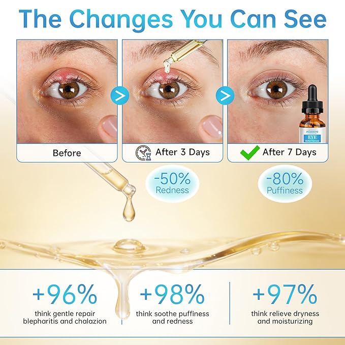 Eye Serum For Chalazion & Blepharitis, 30ML Chalazion Remover For Eyelid, Blepharitis Eyelid Serum With Avocado Oil, Sea Buckthorn Oil & Caffeine, Relieve Puffiness and Eye Fatigue