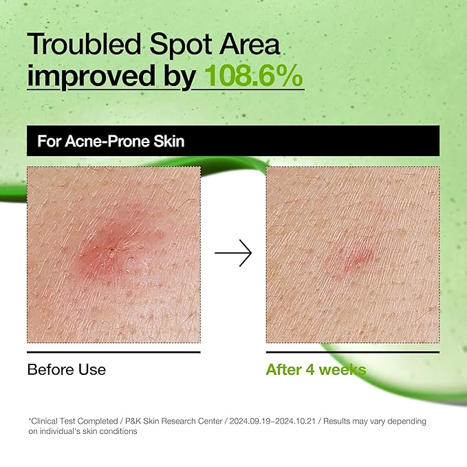 Anua Azelaic Acid 10 Hyaluron Redness Soothing Serum, Facial Serum for Blemish-Prone & Sensitive Skin, Lightweight & Hydrating Blemish Care, Hyaluronic Acid, Korean Skincare, 1.01 fl oz.