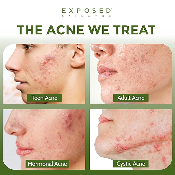 Exposed Skin Care, Basic Acne Treatment Kit with 2.5% Salicylic Acid and 3.5% Benzoyl Peroxide to Clear Up Teen, Adult, Hormonal and Cystic Acne – Natural, Non-toxic and Cruelty Free