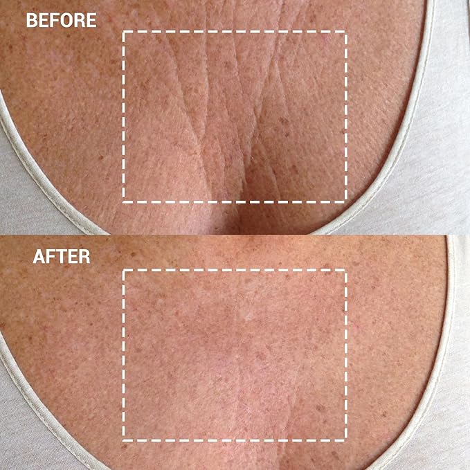 Wrinkles Schminkles Chest Wrinkle Patch & Cleanser Starter Pack - Set of Reusable Chest Silicone Wrinkle Patches + Patch Cleanser (2 oz) Maximise Uses - Smooth & Prevent Décolletage Wrinkles