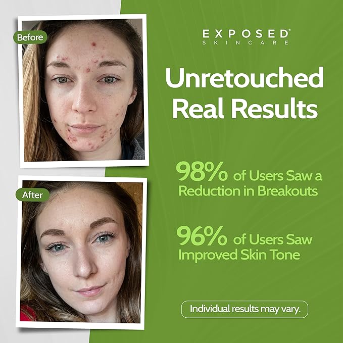 Exposed Skin Care, Basic Acne Treatment Kit with 2.5% Salicylic Acid and 3.5% Benzoyl Peroxide to Clear Up Teen, Adult, Hormonal and Cystic Acne – Natural, Non-toxic and Cruelty Free