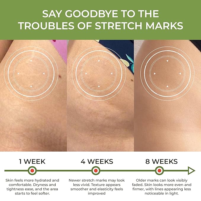 Abera Maternity Stretch Mark Cream for Pregnancy and Weight Fluctuations, Stretch Mark Treatment Pregnancy Must Haves, Deep Stretch Mark Removal