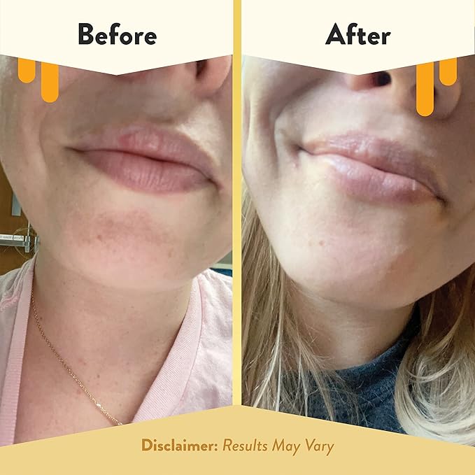 ECZEMA HONEY Nourishing Lip Balm - Organic Chapstick for Sensitive Skin - Daily Lip Moisturizer for Very Dry Lips - Mango Butter & Honey Lip Balm - Natural Lip Care Products (1 Ct) (Pack of 2)
