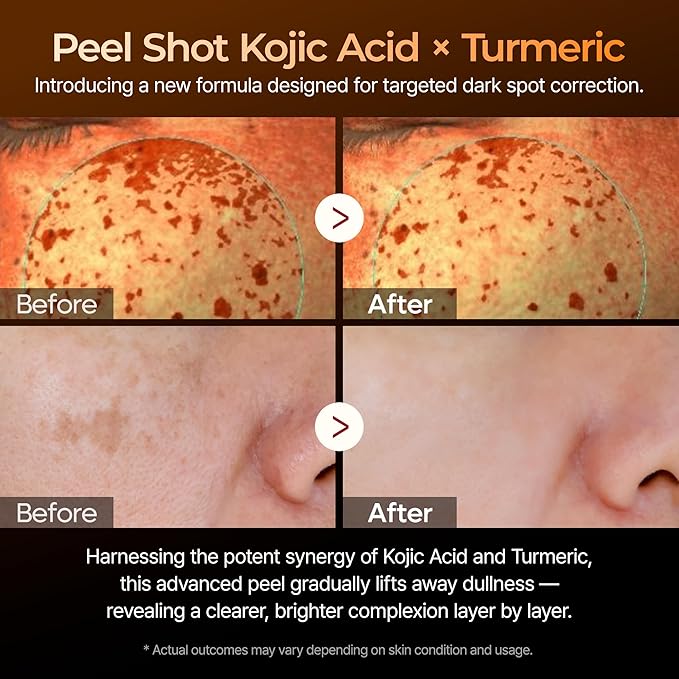 Dr. Melaxin Peel Shot Kojic Acid Turmeric Serum – Exfoliating Dark Spot Corrector with AHA/BHA & Niacinamide, Brightening & Even Tone Facial Serum (80ml / 2.70 fl oz)