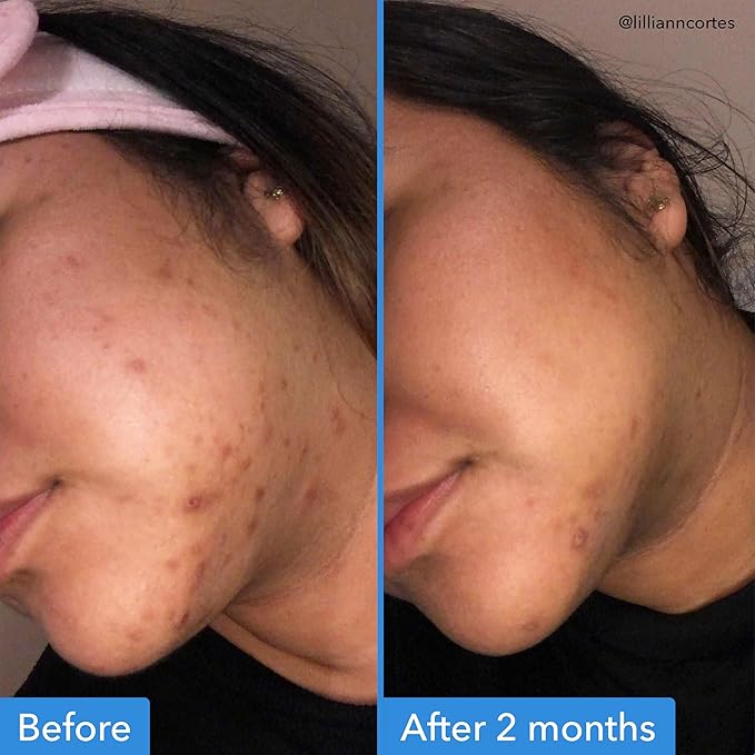 Good Molecules Discoloration Correcting Serum Pack 3 – 30 ml Each | Tranexamic Acid & Niacinamide Serum for Dark Spots and Hyperpigmentation, Skin Care for Face