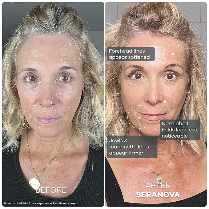Seranova Micro Infusion System for Face & Neck 0.05mm Stamp with Hyaluronic Acid & Collagen Peptide Serum for Firmer Smoother-Looking Skin, Easy 5-Minute At-Home Skin Care Application - 2 Month Supply